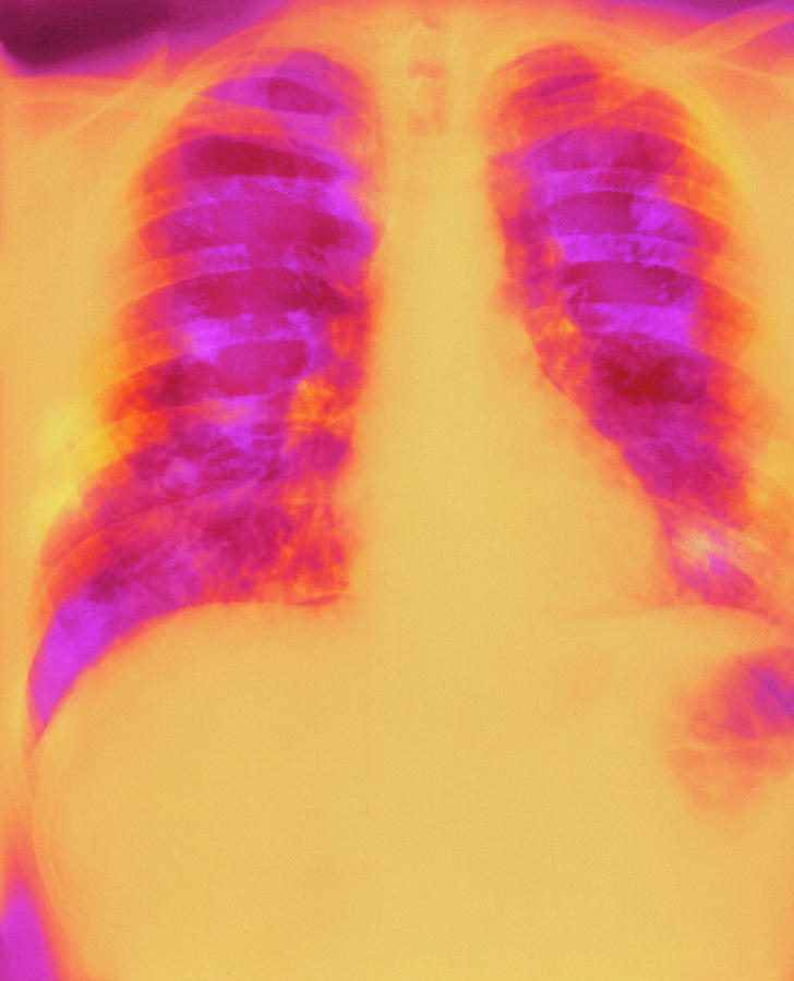Coloured X-ray Of Secondary Lung Cancer Photograph by Science Photo Library