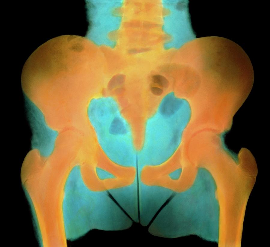 Skeleton Photograph - Coloured X-ray Of The Pelvis Of A 13-year-old Girl by Science Photo Library