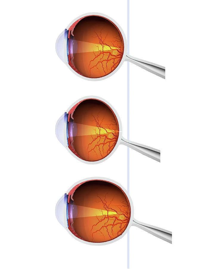 eye-defects-myopia-its-causes-symptoms-and-treatment