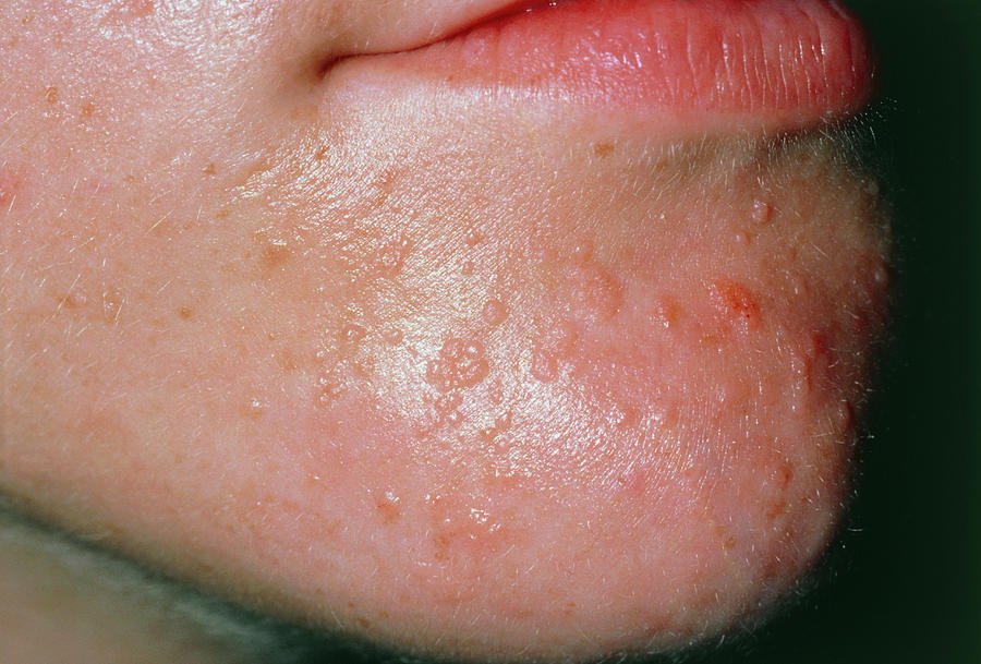 Common Warts On Boy's Chin Photograph By Dr P. Marazzi Science Photo 