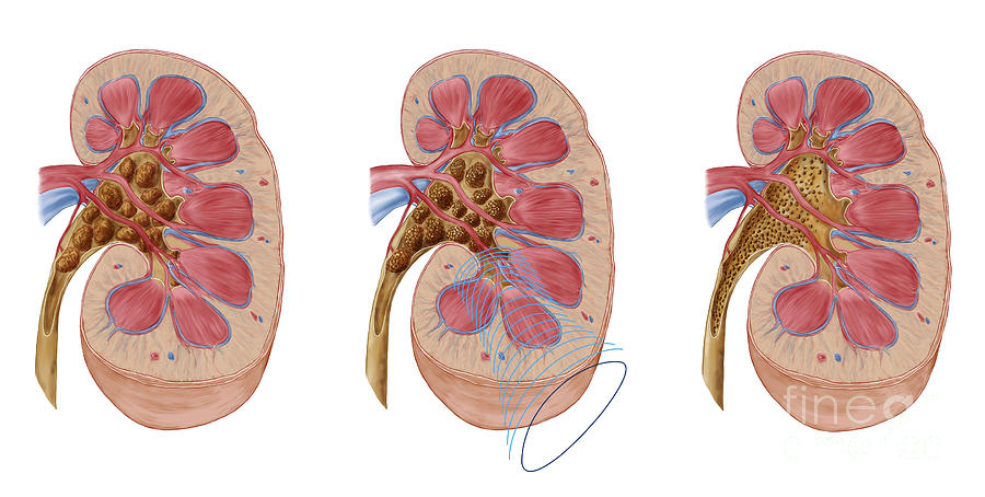 Healthcare Digital Art - Comparison Of Different Sized Kidney by Stocktrek Images