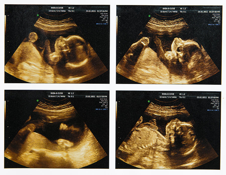 Compilation of four fetus ultrasounds Photograph by Pedre