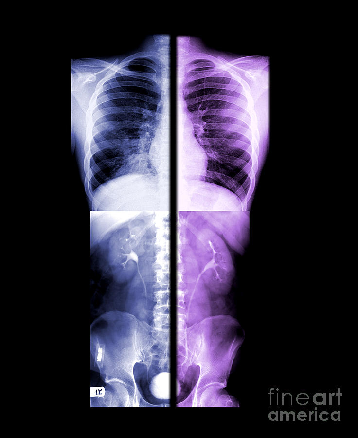 Ivp Photograph - Composite X-rays Of Kidneys by Living Art Enterprises