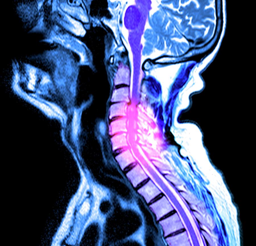 Compressed Spinal Cord Photograph by Du Cane Medical Imaging Ltd | Fine ...