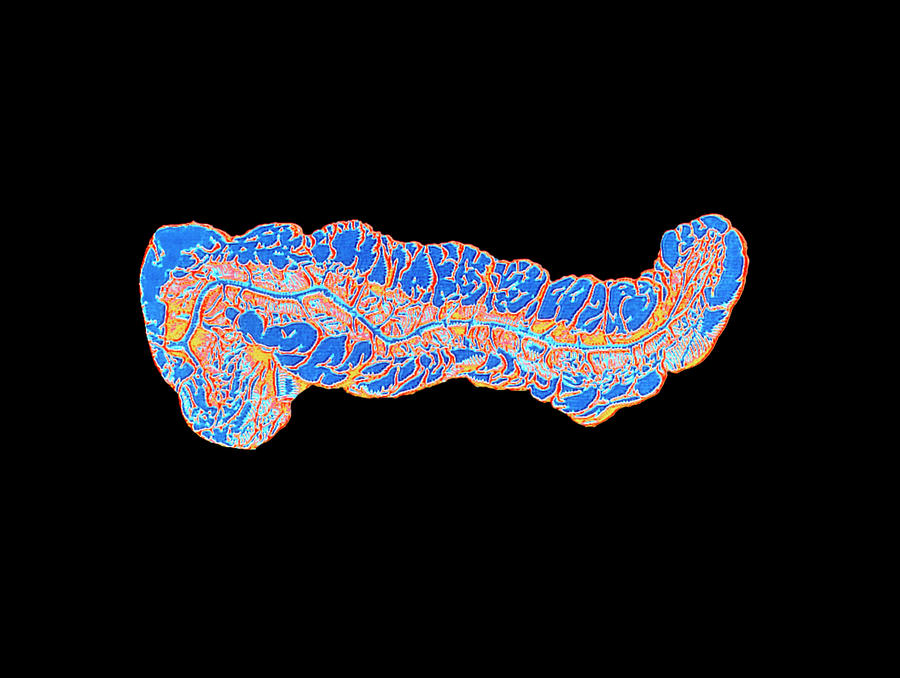 Computer Graphic Of A Human Pancreas Photograph by Alfred Pasieka/science Photo Library