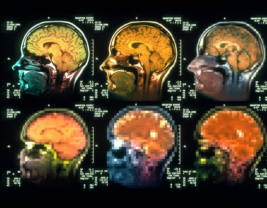 Conceptual Mri Scans Of A Brain Disorder Photograph by Simon Fraser ...