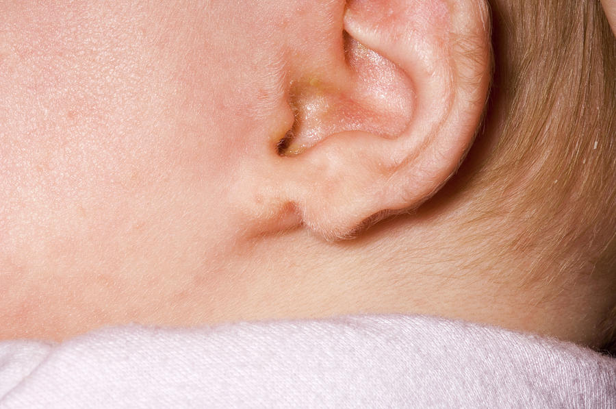 Congenital Split Ear Lobe Photograph by Dr P. Marazzi/science Photo Library