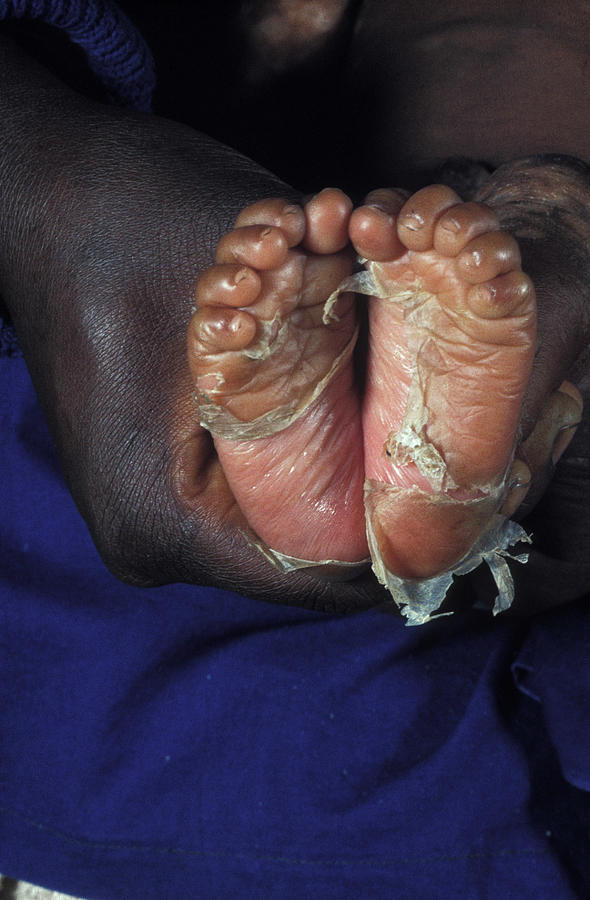 Congenital Syphilis Photograph by Dr M.a. Ansary/science Photo Library