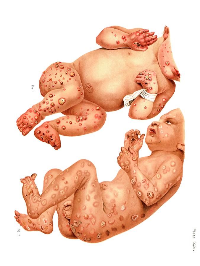 congenital syphilis baby