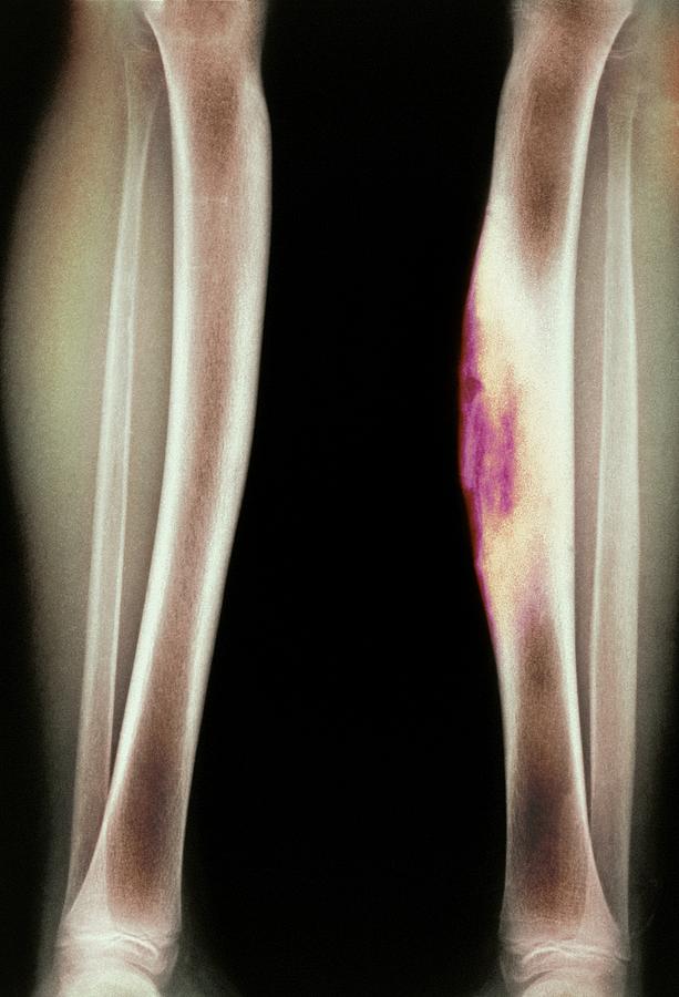 Disease Photograph - Congenital syphilis, X-ray by Science Photo Library