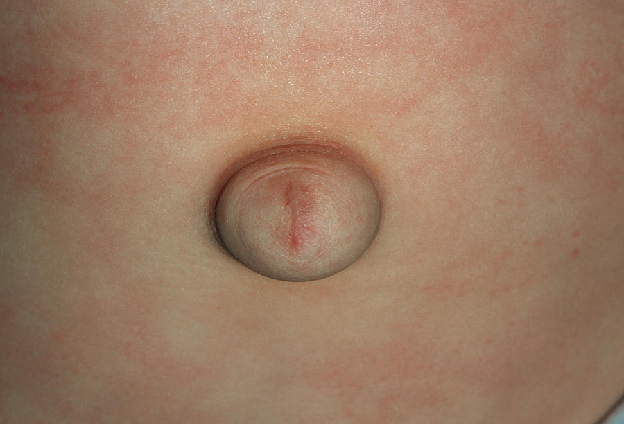 Congenital Umbilical Hernia In A 1-year-old Child Photograph by Dr P