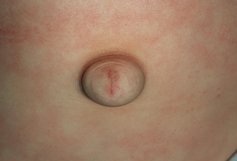 congenital-umbilical-hernia-in-a-1-year-old-child-photograph-by-dr-p