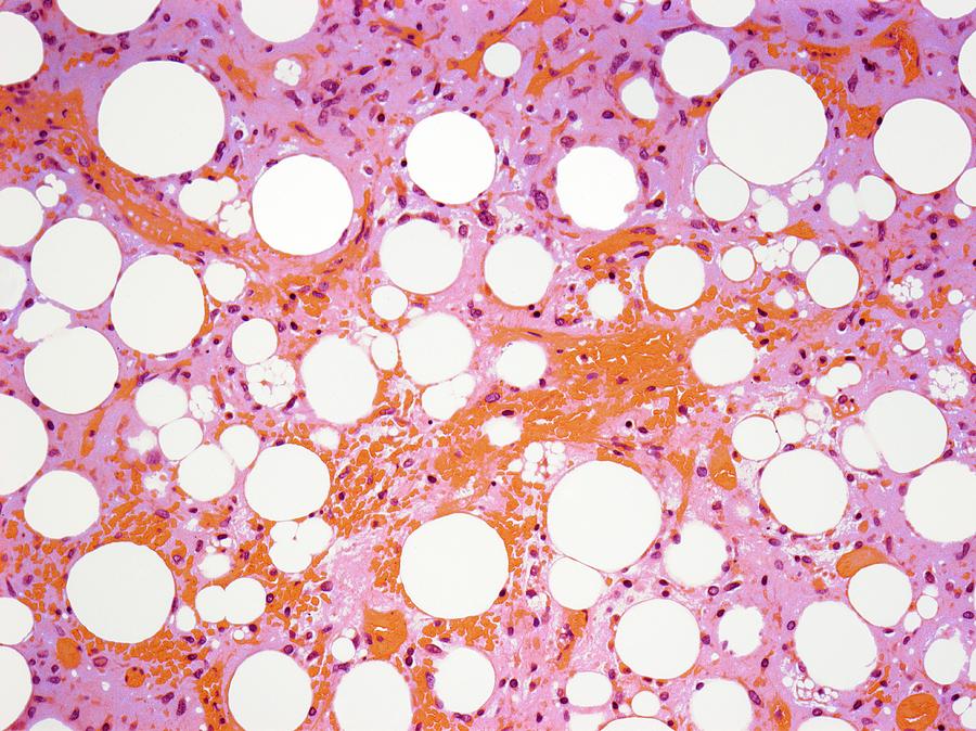 Disease Photograph - Connective Tissue Cancer by Steve Gschmeissner