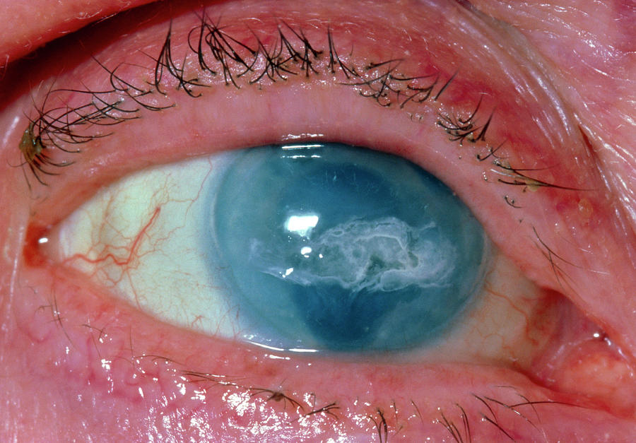 Corneal Calcification And Scarring After Surgery Photograph by Dr P