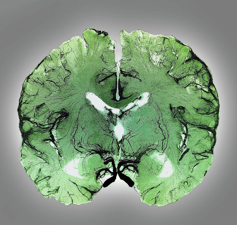 Coronal Brain Slice Specimen Photograph by Zephyr/science Photo Library