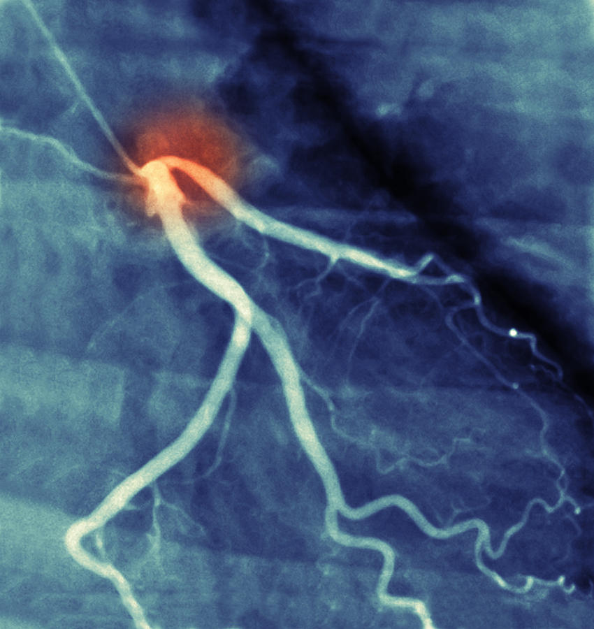 Coronary Artery Disease Photograph by Voisin/Phanie