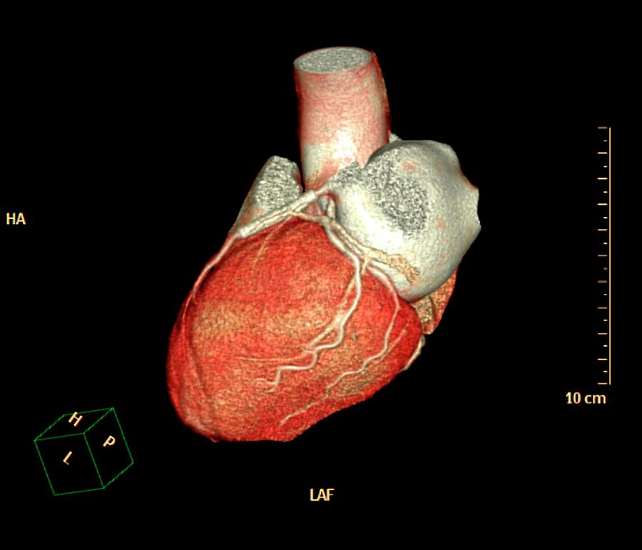 Coronary Artery Stent Evaluation Photograph by Zephyr/science Photo ...