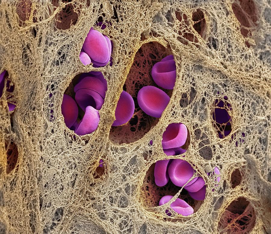 Coronary Blood Clot Photograph by Steve Gschmeissner/science Photo Library