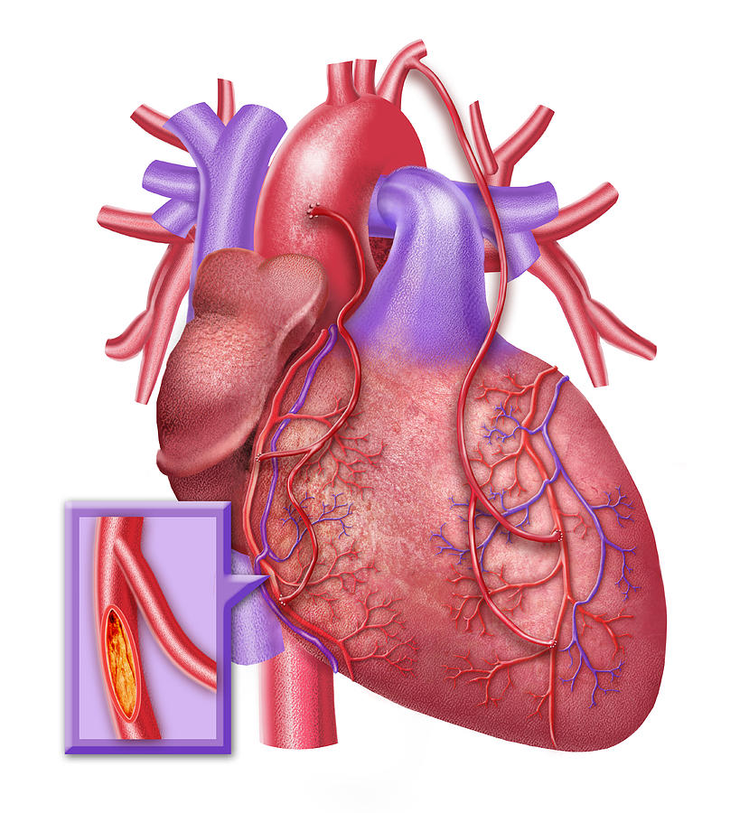 Coronary Bypass Grafts Photograph By Chris Bjornberg - Pixels