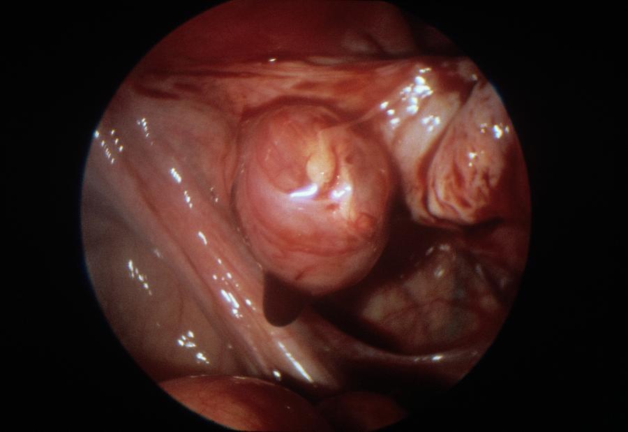 Corpus Luteum In Ovarian Cycle Photograph by Dr J. P. Abeille/science Photo Library