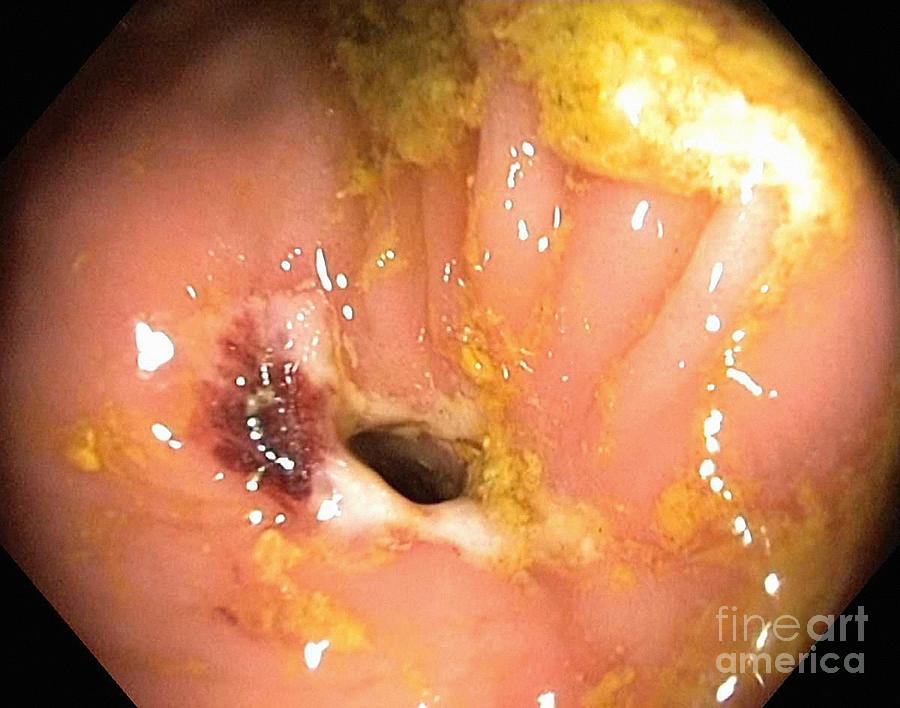 Digestive System Photograph - Crohns Disease, Endoscopic View by Gastrolab