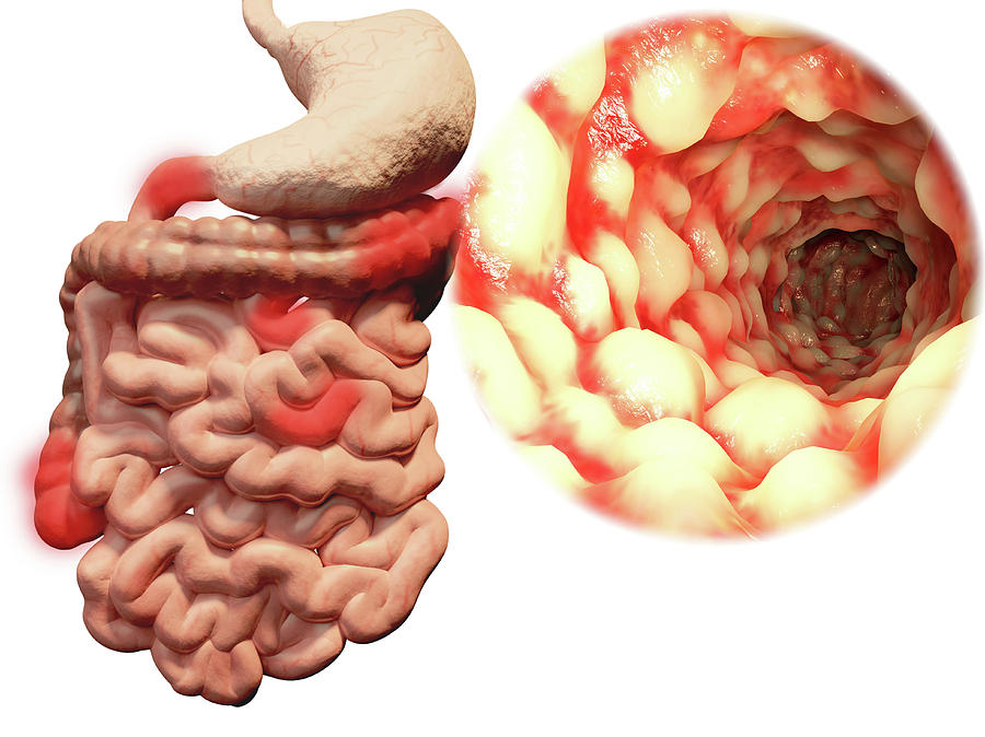 Crohns Disease, Illustration Photograph by Juan Gaertner