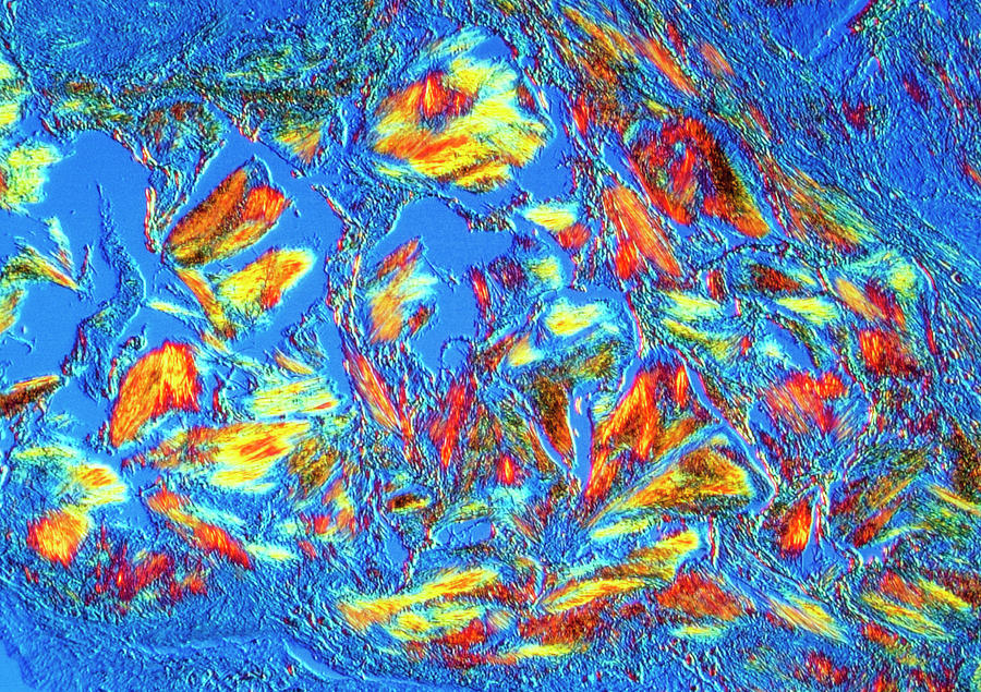 Crystals In Gout Photograph by Alfred Pasieka/science Photo Library