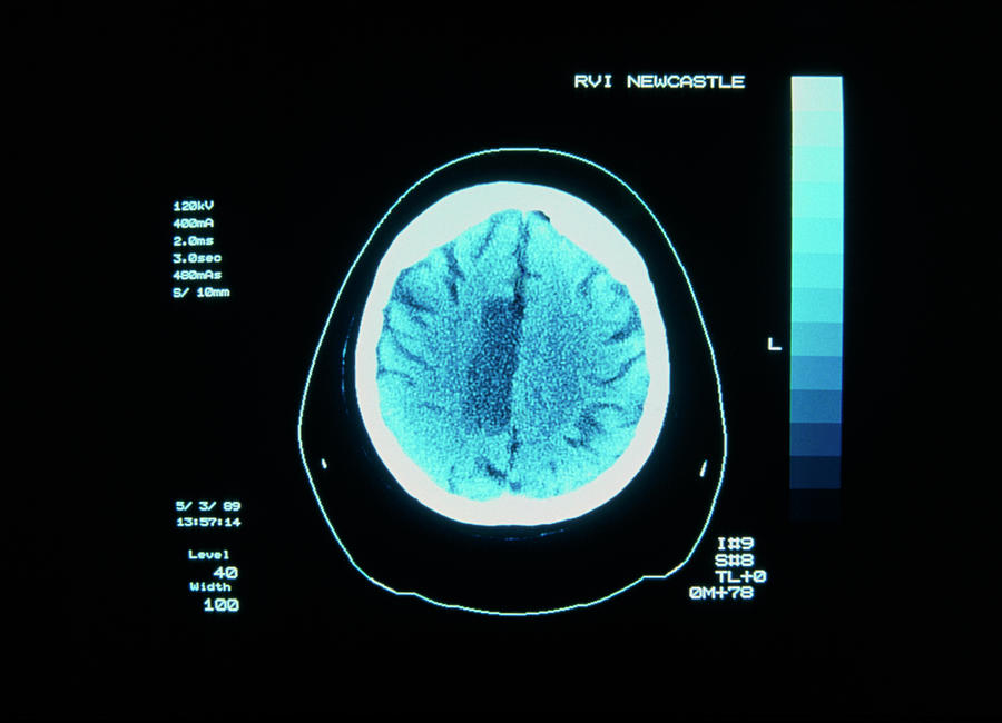 Ct Brain Scan Showing Stroke (or Cva) Photograph by Simon Fraser/rvi ...