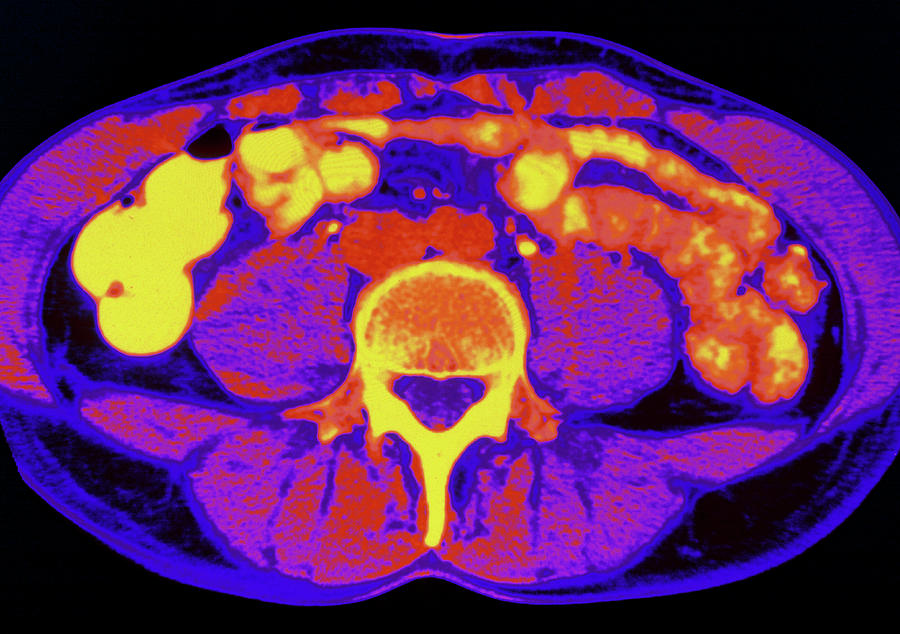 Abdomen Photograph - Ct Scan Of Abdomen by Alfred Pasieka/science Photo Library