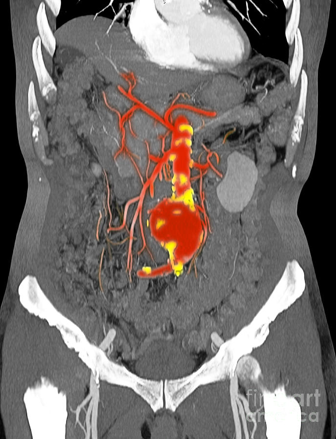 Ct Scan Of Abdominal Aortic Aneurysm Photograph by Scott Camazine