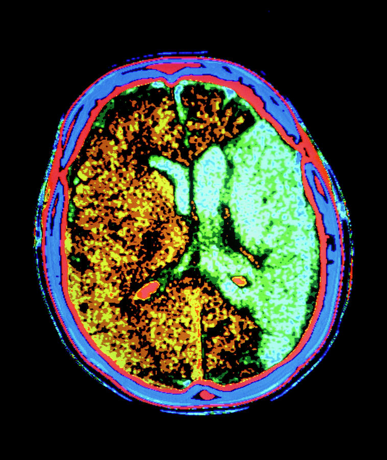 Ct Scan Of Brain With Cerebral Infarction Photograph by Gca/science ...