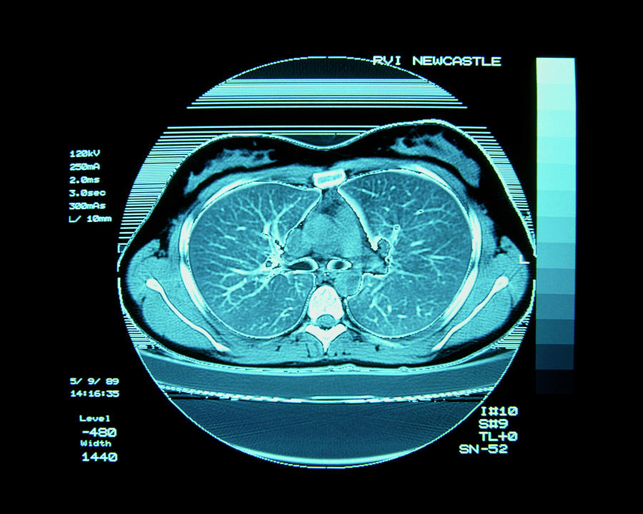 what-can-a-chest-ct-scan-show-a-doctor-about-heart-problems