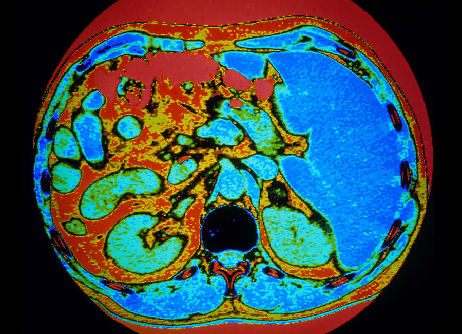 Adrenal Gland Photograph - Ct Scan Of Human Adrenal Gland by Gca/science Photo Library