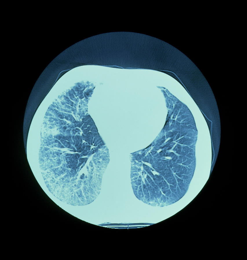 lung dead space disease