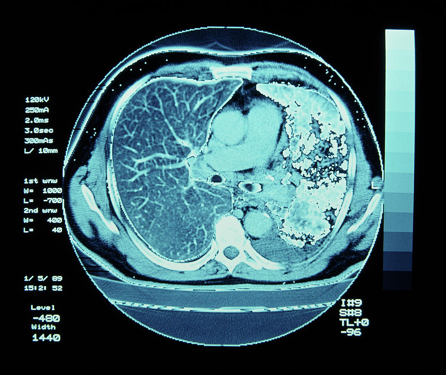 Ct Scan On Chest Showing Lung Cancer by Simon Fraser/science Photo Library