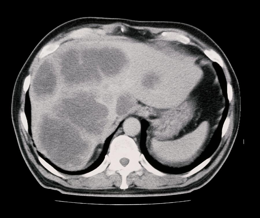 Ct Scan Showing Cancer Of The Liver Photograph by Science