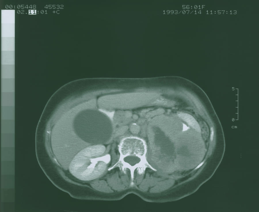 Ct Scan Showing Kidney Cancer (axial Section) Photograph by Science