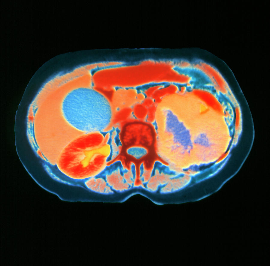 Ct Scan Showing Kidney Cancer Photograph By Dept Of Clinical Radiology