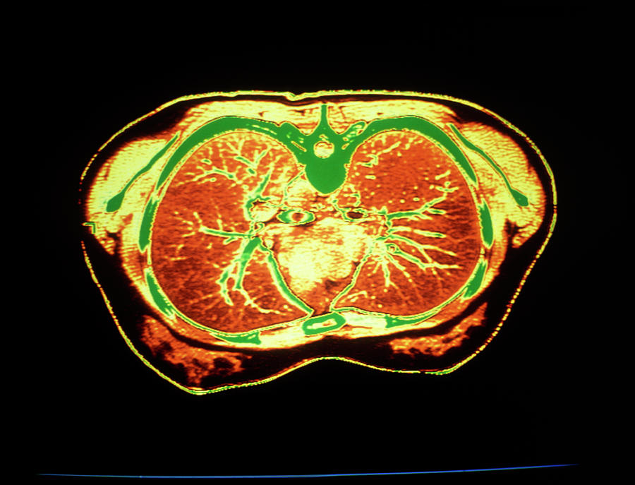 Ct Scan Showing Normal Lungs Photograph By Simon Fraserscience Photo