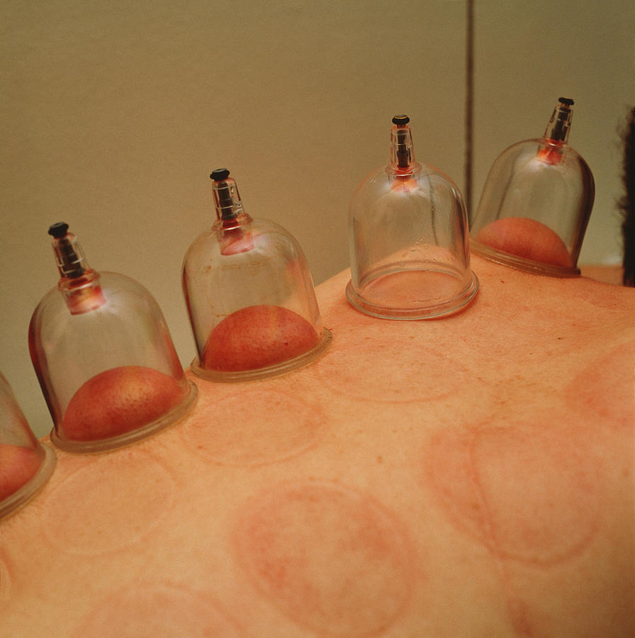 Cupping Therapy Photograph by Mark De Fraeye/science Photo Library