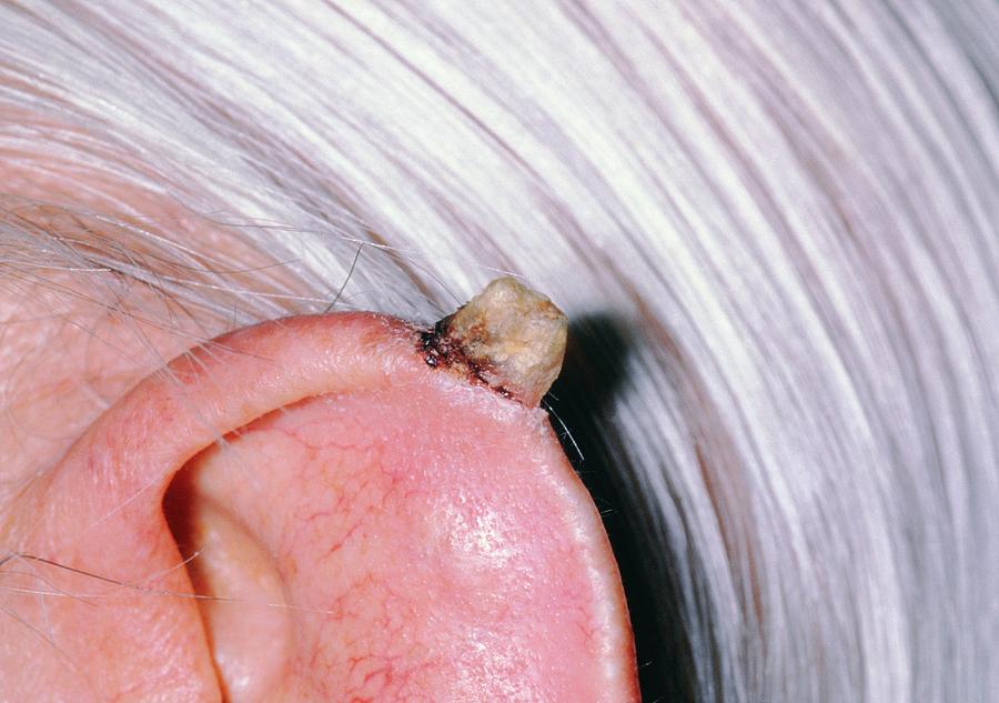 Cutaneous Horn On Ear Photograph By Dr P Marazziscience Photo Library 2072