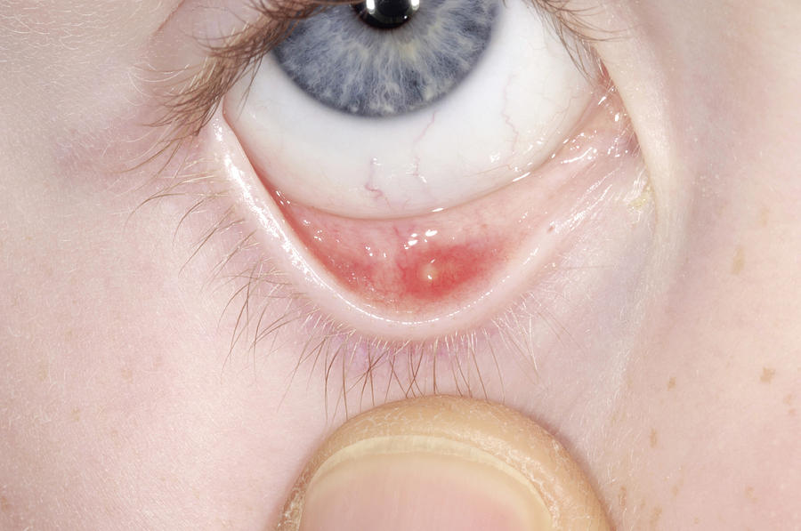 Cyst Chalazion On Eyelid Photograph By Dr P Marazzi Science Photo Library