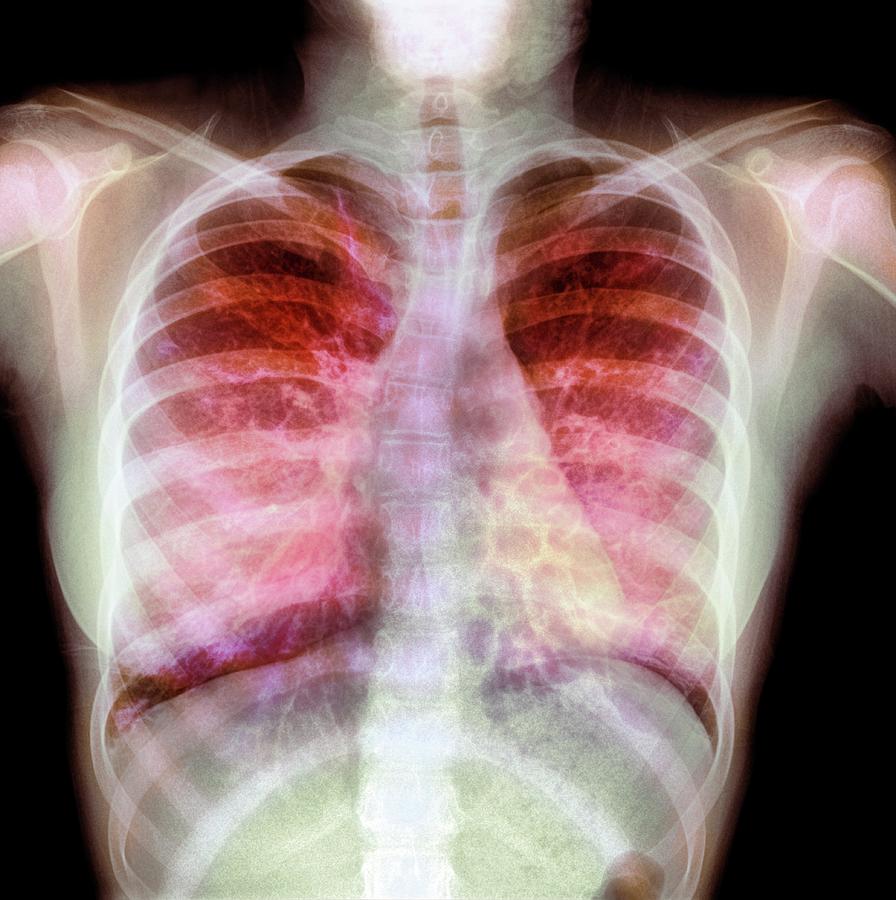 Cystic Fibrosis Photograph by Photostock-israel/science Photo Library
