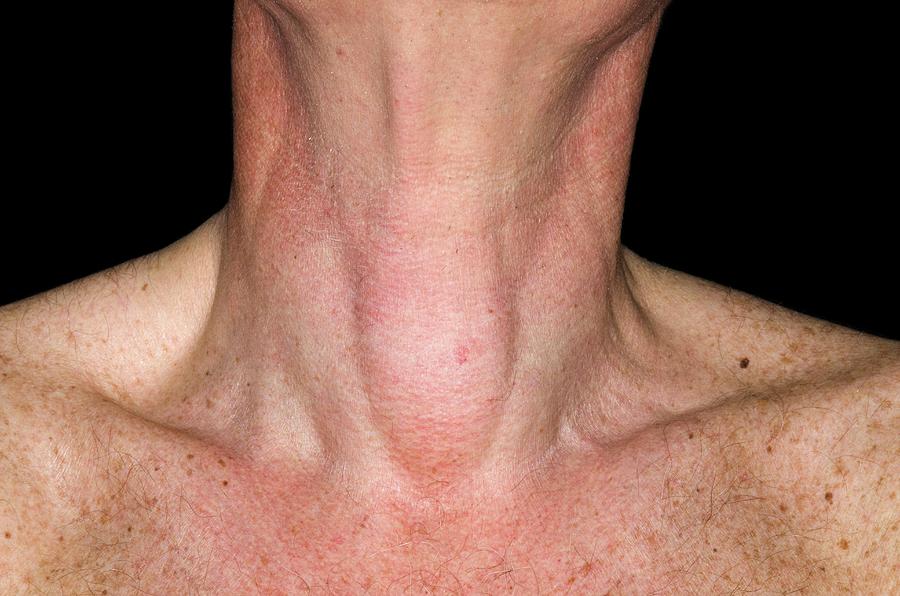 Thyroid Learn About Thyroid Diseases Such As Hypothyroidism Cr84fn