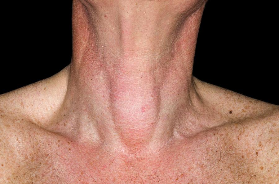 Can Thyroid Nodules Cause Throat Discomfort