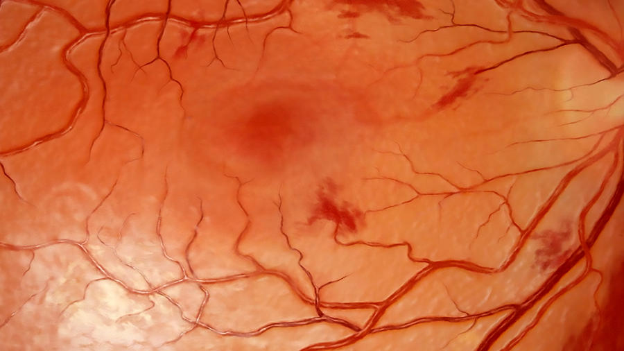 Damaged Retina, Hypertension Photograph by Anatomical Travelogue