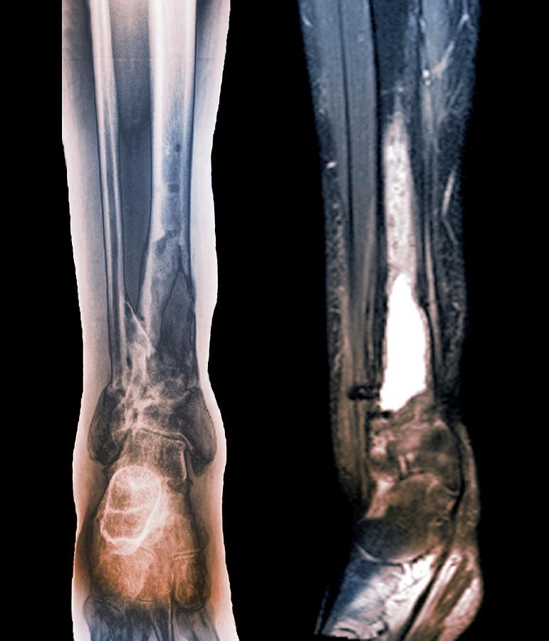 Damaged Tibia Photograph by Zephyr/science Photo Library