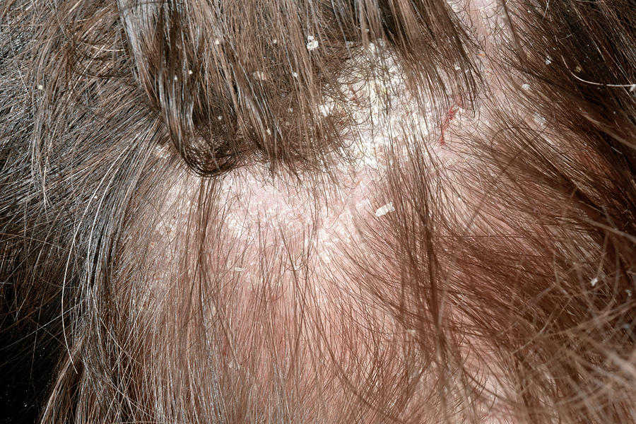 Dandruff In Seborrheic Dermatitis Photograph by Dr P. Marazzi/science ...