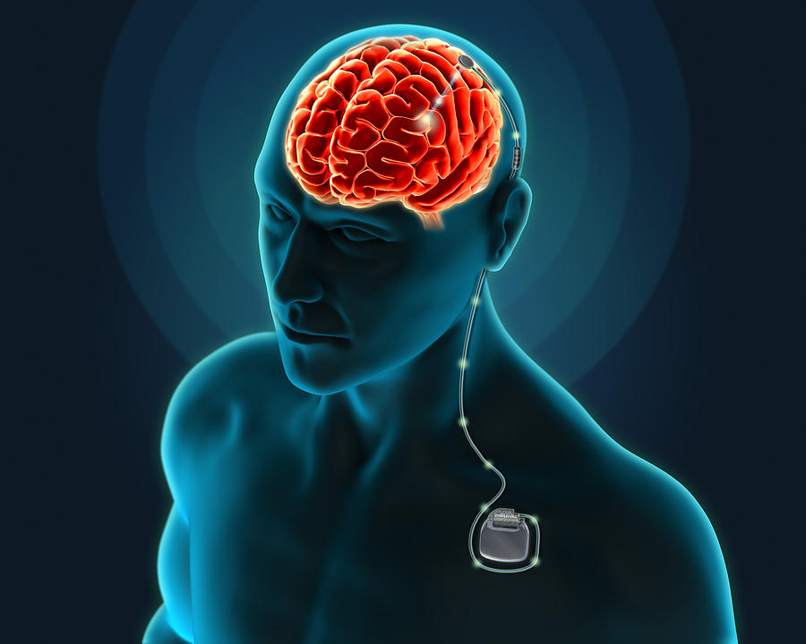 Deep Brain Stimulation, Illustration Photograph by Evan Oto