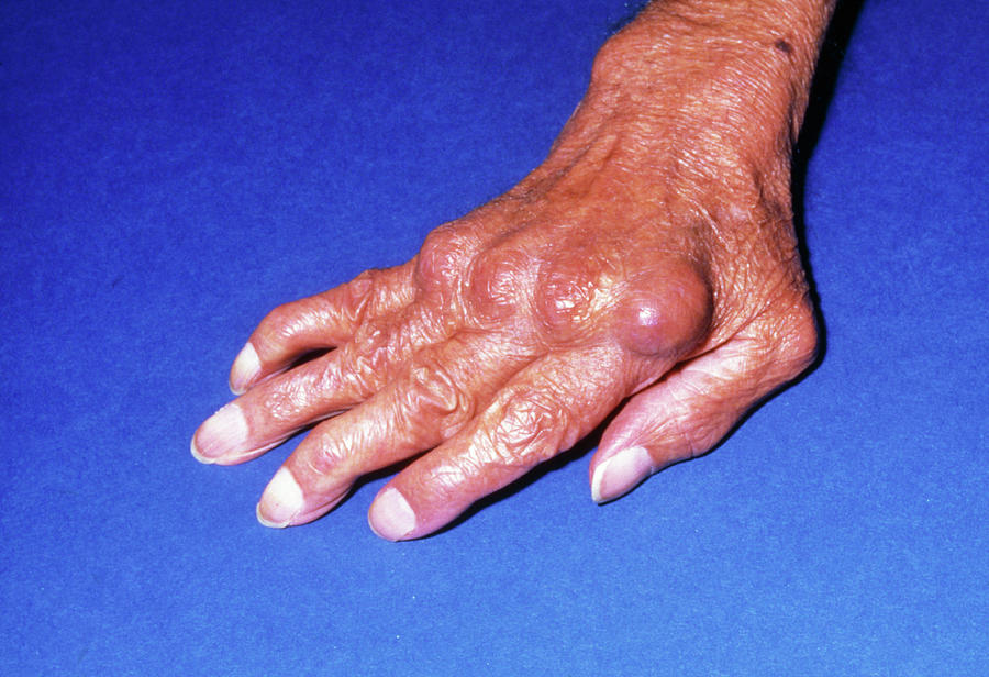 Deformation Of Hand Due To Rheumatoid Arthritis Photograph by James Stevenson/science Photo Library